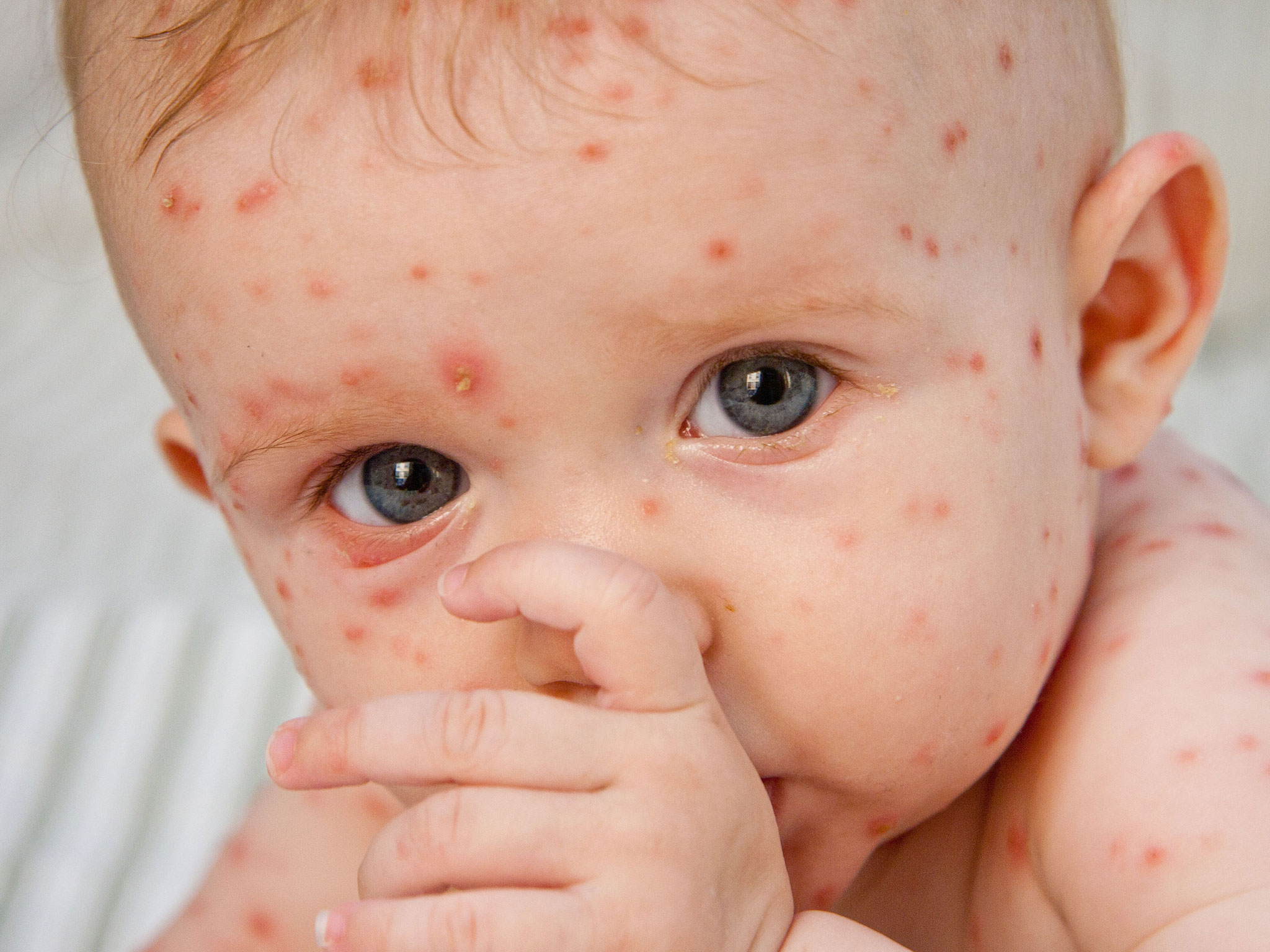 Difference Between Chickenpox And Smallpox In Hindi